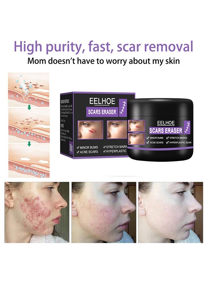 Scars Eraser - Scar Removal Gel, Scar Removal Cream, Acne Scar Treatment，Deep Acne Scar Removal, Burns Keloids Hypertrophic, Repair Damaged Skin, Removing Acne Marks Scar Repair Cream 50g﻿
