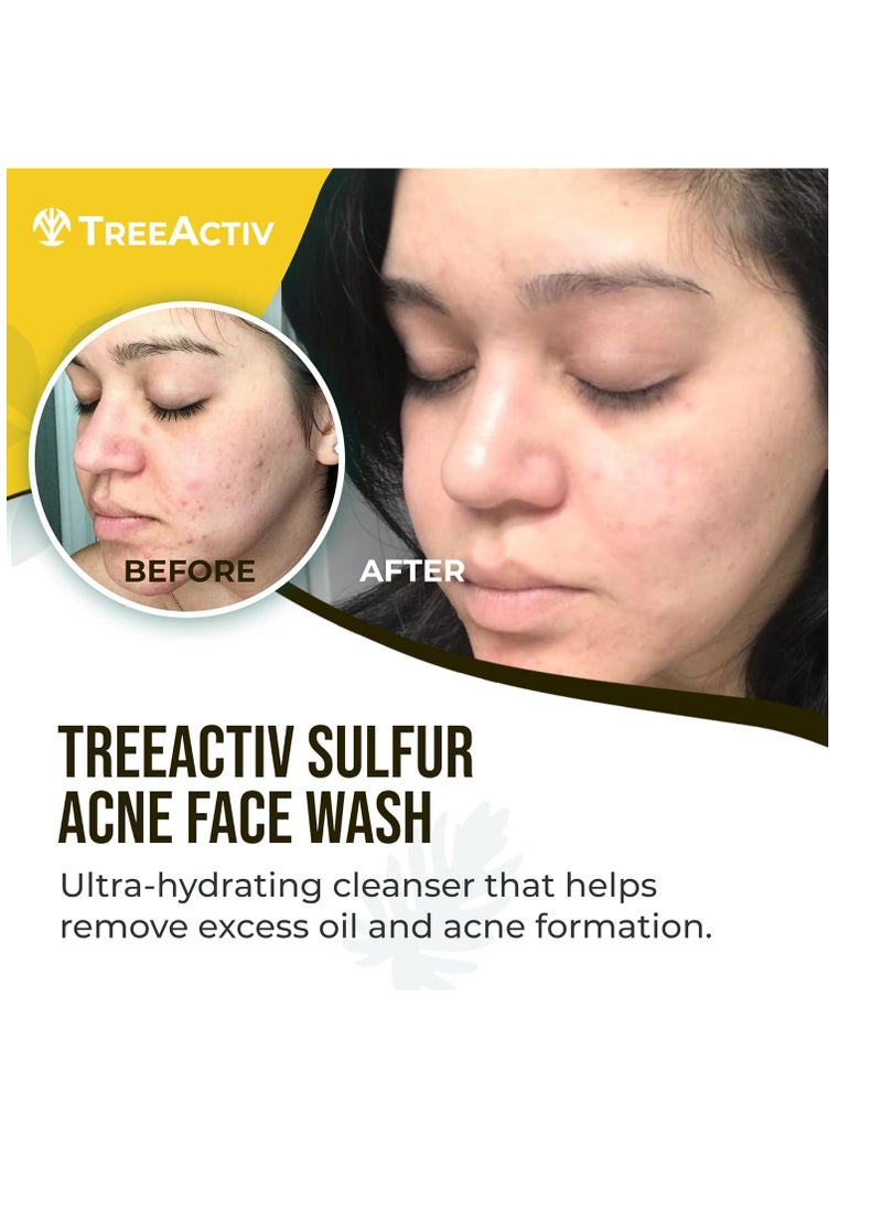 TreeActiv Sulfur Acne Face Wash Original Formula, 8 fl oz, Exfoliating Acne Face Wash for Men & Women, Sulfur Acne Wash for Acne, Activated Charcoal & Pumice, Foaming Daily Women and Men's Face Wash