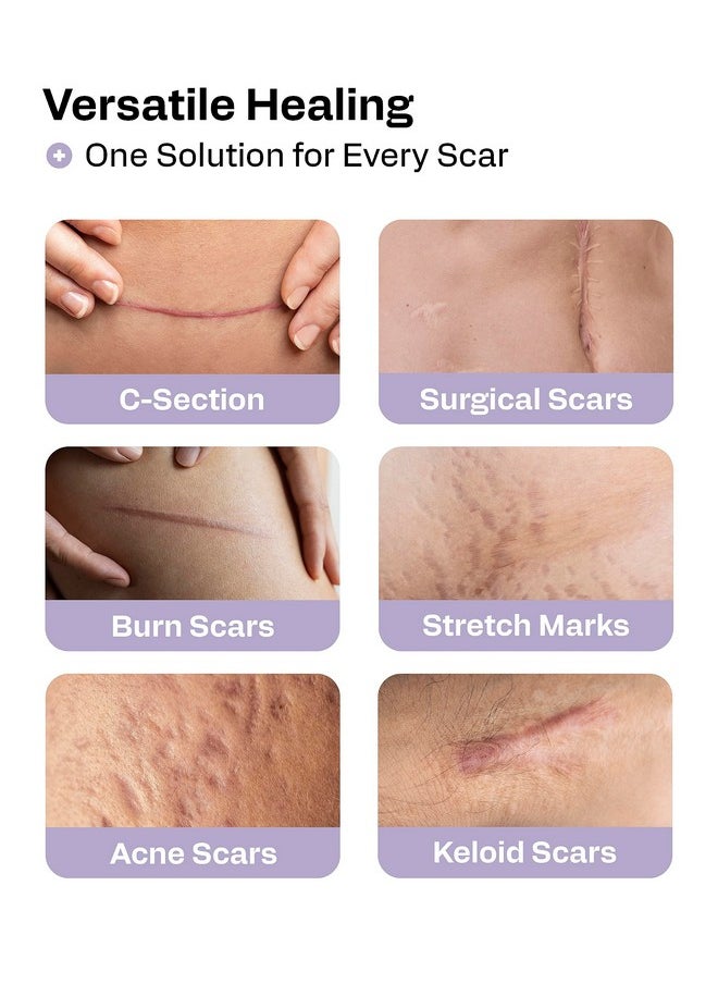 AWD Silicone Scar Sheets for Surgical Scars - Silicone Scar Tape for C Section, Tummy Tuck Tape, Keloid Treatment - Silicone Skin Patches After Surgery Must Haves (1.6