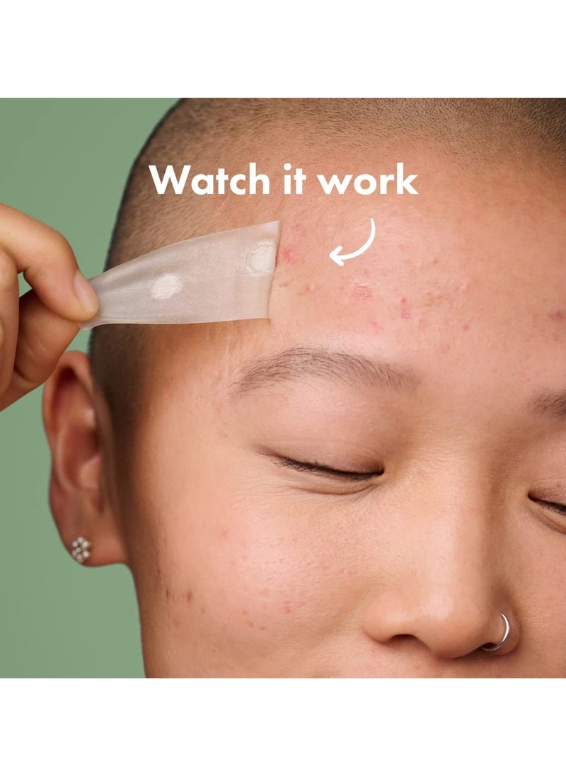 Surface - Hydrocolloid Large Acne Pimple Patch Spot Treatment (10 count) for Body and Larger Breakouts on Cheek, Forehead, Chin, Vegan, Cruelty-Free, 50% Better Absorption