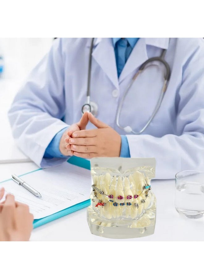 Orthodontic Demonstration Model with Stainless Steel Brackets and Colorful Ligatures - Misaligned Teeth Correction Display on Transparent Acrylic Base - Ideal for Educational and Training Purposes