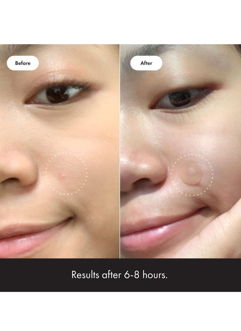 Hydrocolloid Acne Pimple Patch Spot Treatment 36- Piece