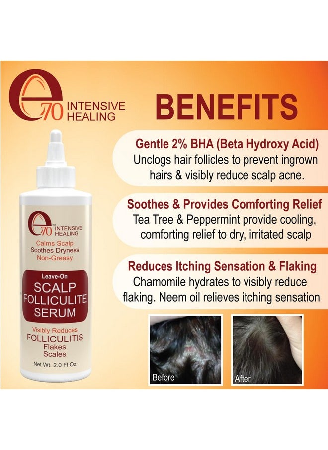 Folliculitis Treatment Clarifying Serum with Salicylic Acid to Remove Build Up, For Normal to Oily Scalp. Prone to Folliculitis, Dandruff, Itchy & Flaky Scalp, Seborrheic Dermatitis Paraben-Free.