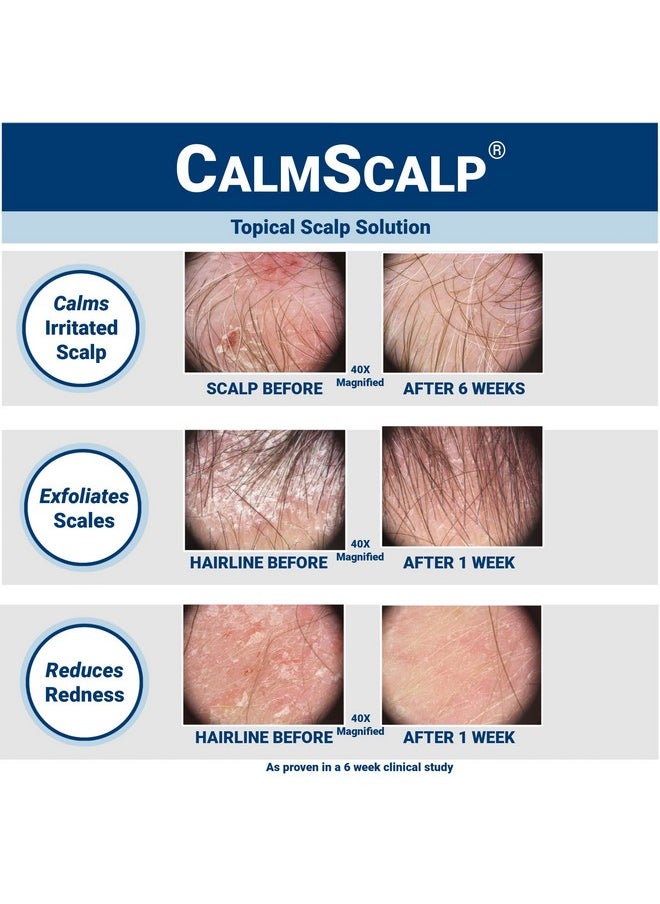 CalmScalp Topical Solution for Symptoms of Mild to Moderate Psoriasis | Irritated Scalp | Hairline Scales | Redness | Dry Scalp | Made in The USA | 4 oz.