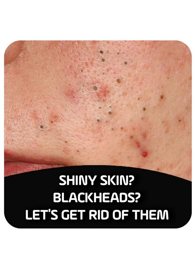 Activated Charcoal Cleansing Bar For Enhanced Acne Control & Skin Purification With 2% Salicylic Acid, Ideal For Oily Skin And Reducing Blackheads - 4 Oz, 5-Pack