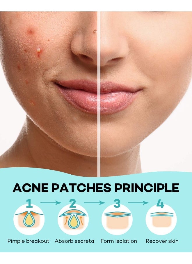 Acne Patch Pimple Patch, 4 Sizes 140 Patches Acne Absorbing Cover Patch, Hydrocolloid Invisible Acne Patches For Face Zit Patch Acne Dots Tea Tree, Calendula Oil