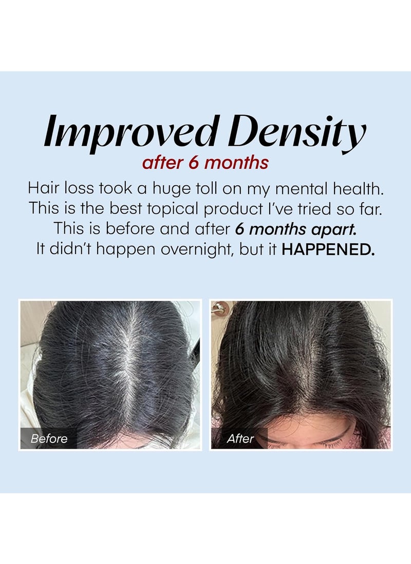 Topical Hair Growth Treatment with Scalphy Viral Effect for Hair Loss, Thinning and Retrieving Hairline | Scalp Massager with Scalphy Ball