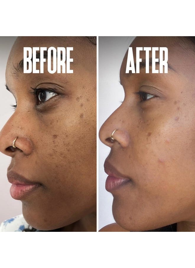 Dark Spot Corrector, Dark Spot Remover for Face - For Stubborn Dark Spots Serum, Dark Spot Remover with Kojic Acid, Alpha Arbutin, Mulberry Extract, Brightening Discoloration Correcting Serum