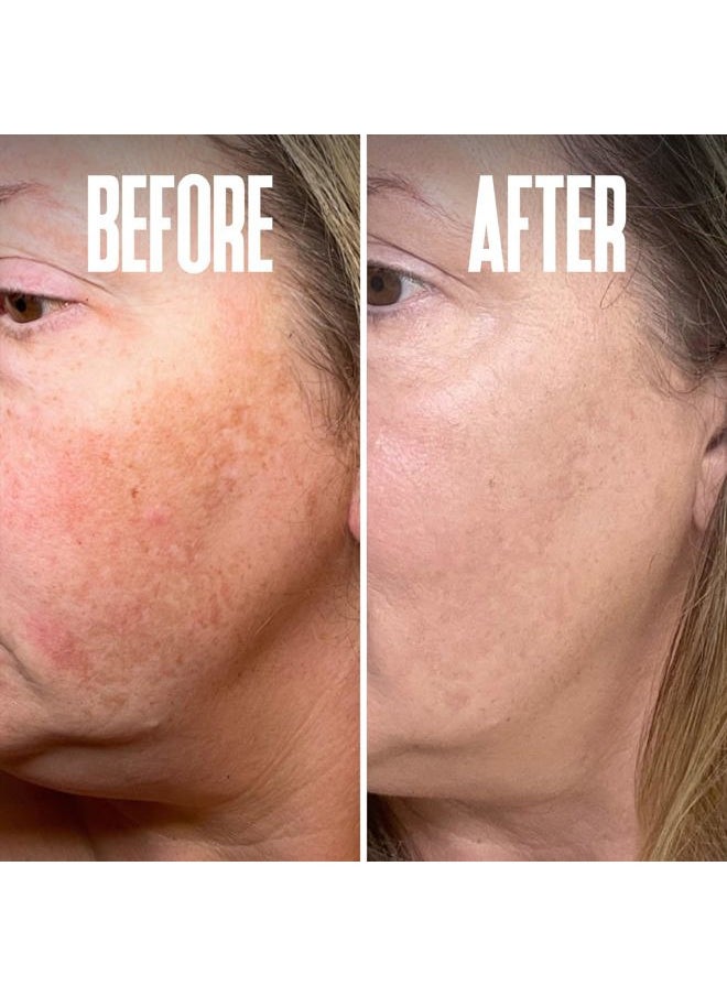 Dark Spot Corrector, Dark Spot Remover for Face - For Stubborn Dark Spots Serum, Dark Spot Remover with Kojic Acid, Alpha Arbutin, Mulberry Extract, Brightening Discoloration Correcting Serum