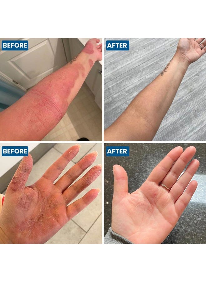 C+ Eczema Cream Dermatitis Treatment - Lotion for Extremely Dry Skin, Inflammation, Redness & Itch Relief - Manuka Honey & Calendula - Clinically Proven - Steroid-Free (1 x 1.76oz)