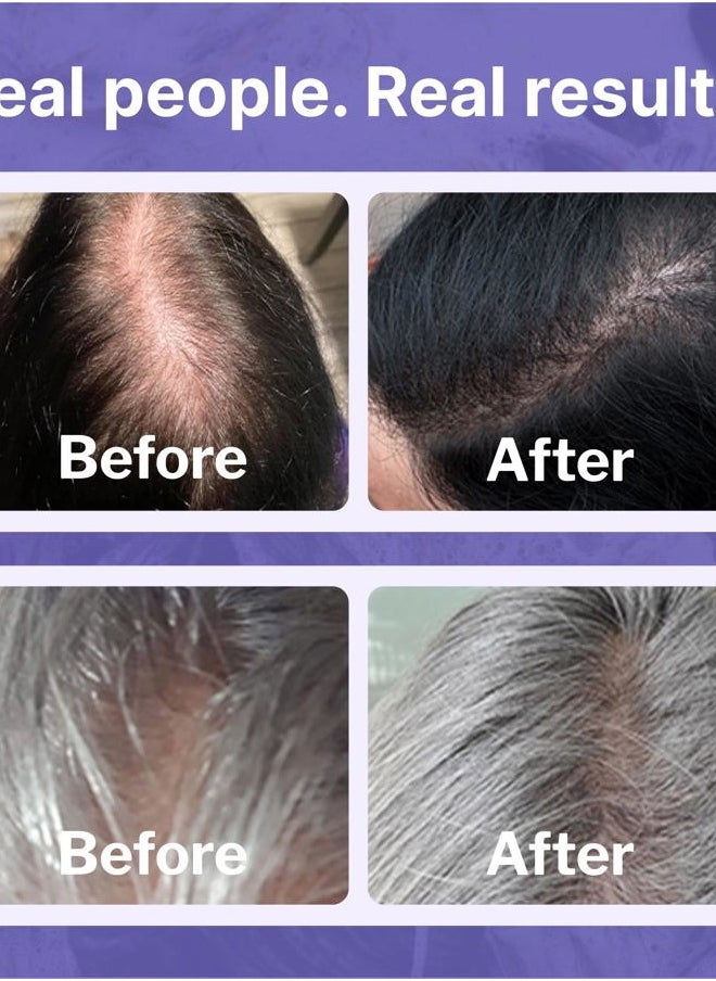 Minoxidil 2% Topical Solution for Women, Serum Promotes Hair Regrowth by Reactivating Hair Follicles (1 Month)