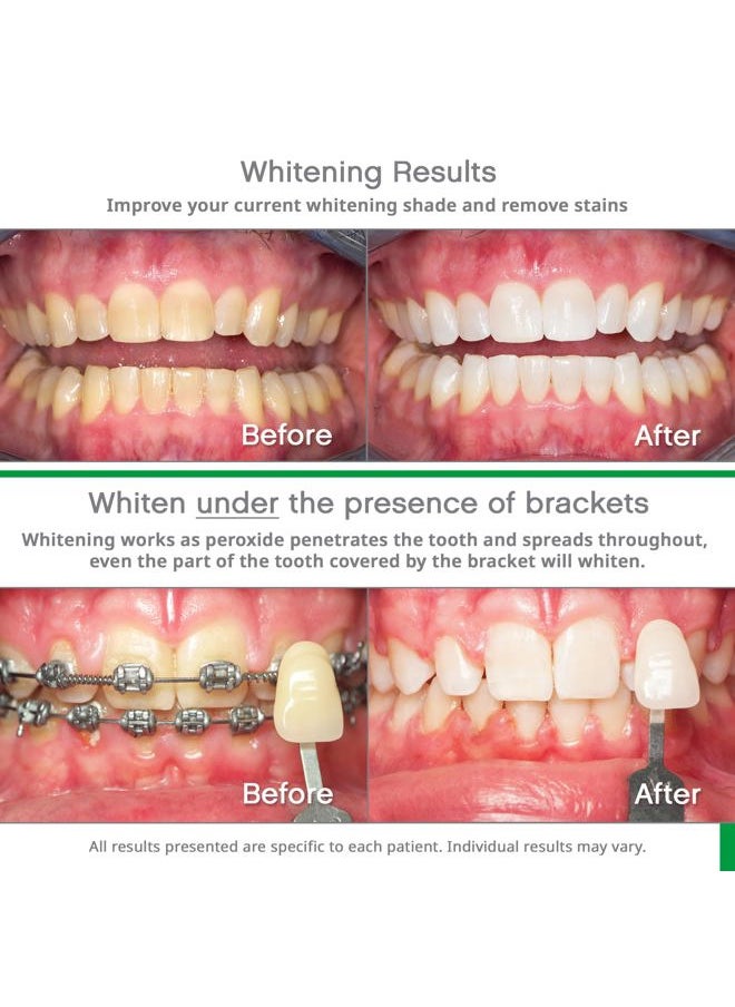 Go 10% - Prefilled Teeth Whitening Trays Kit (10 Treatments) - 10% Hydrogen Peroxide - Mint Made by Ultradent Products. Go Teeth Whitening Kit -Mint- GO10-5193-1