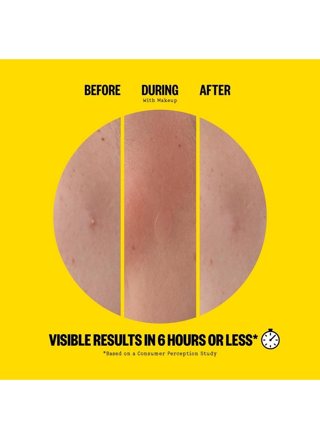 PEACE OUT Skincare Acne Day Dot. 6-hour Fast Acting Sheer Hydrocolloid Pimple Patches with Salicylic Acid, Ultra-Thin, Virtually Invisible, Quickly Clear Breakouts, Blemishes and Zits, 20 dots