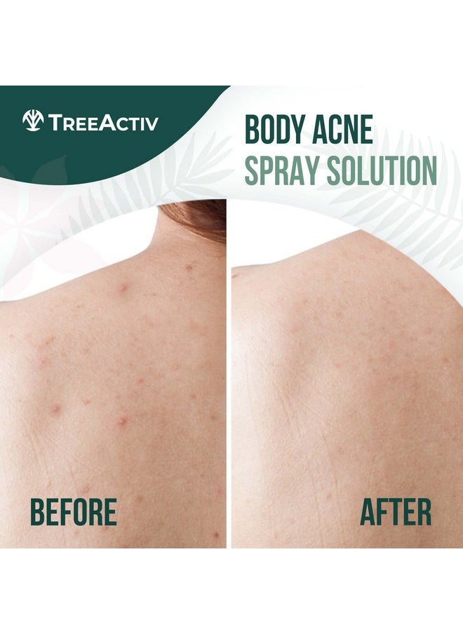 Salicylic Acid Back & Body Acne Spray, Back Acne Solution For Women And Men, Acne Body Spray with Tea Tree Oil, Fast-Drying Back Acne Spray, Fine Mist, Back Acne Treatment Spray, 4 fl oz, 2-pack
