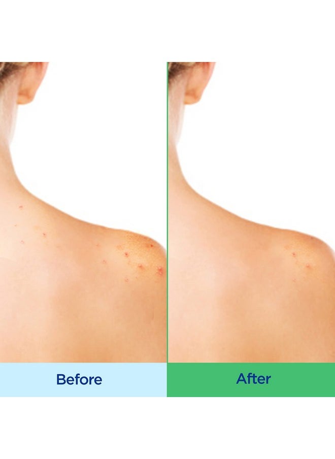 Differin Acne Body Wash by the makers of Differin Gel, Acne Treatment Cleanser with Salicylic Acid, Cream to Lather Formula for Back, Chest, Shoulders, 10 Oz.