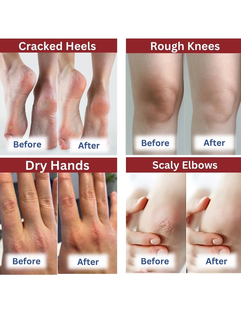 42% Urea Cream Plus 2% Salicylic Acid Cream for Cracked Feet Hands Callus Remover Hand Cream Foot Cream for Cracked Foot Heels Elbows Nails Knees Skin Moisturizer Urea Lotion with Maximum Strength 50G