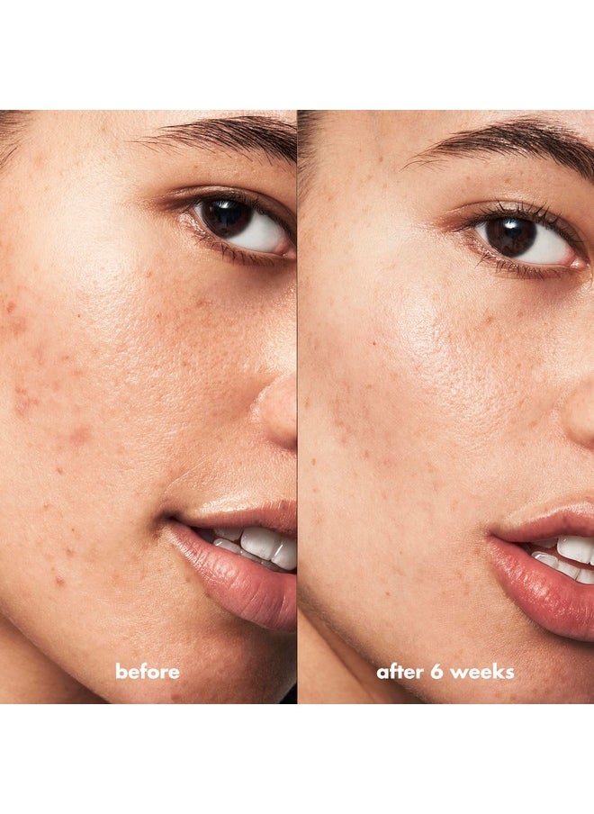 e.l.f. SKIN Blemish Breakthrough Acne Fighting Spot Gel, Roll-on For Treating Blemishes, Made With Salicylic Acid, Vegan & Cruelty-Free