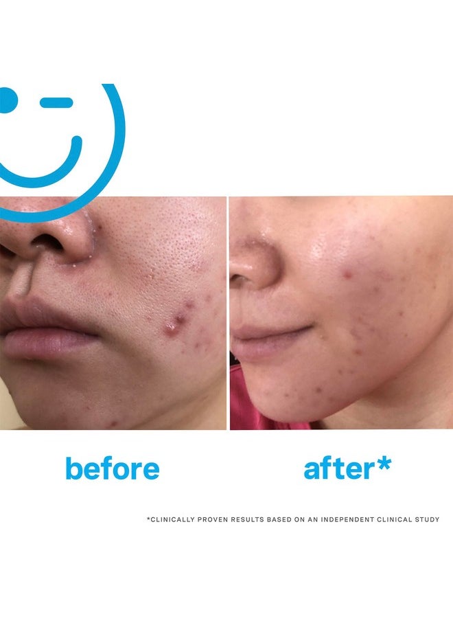 EradiKate 3% Sulfur Daily Foaming Cleanser Acne Treatment - Clinically Formulated Medicated Face Wash Balances Skin and Cleans Pores, 4 Fl Oz