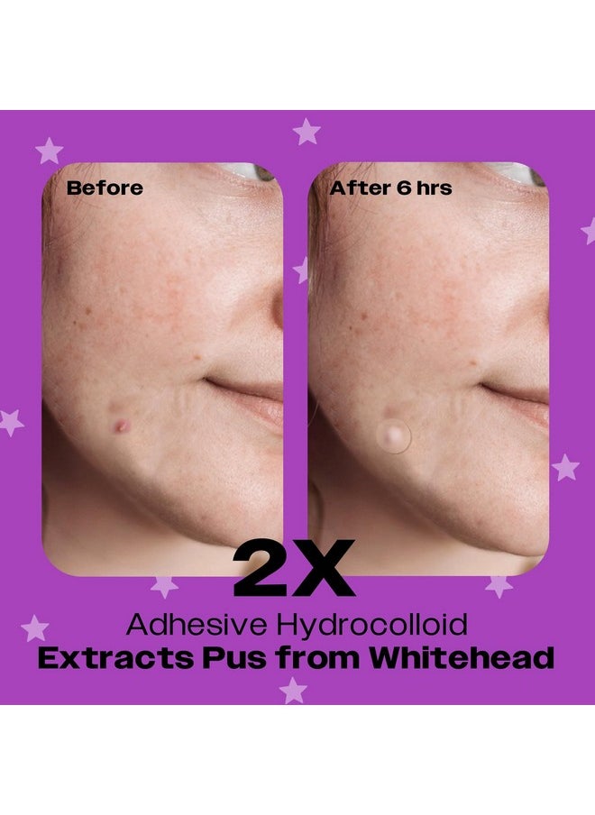 AVARELLE Spot Pimple Patches for Face | ZitOut Good Night Acne Patches | FSA HSA Acne Treatment Hydrocolloid Acne Patches | Hydrocolloid Bandages for Acne with Tea Tree Oil | Acne Spot Treatment