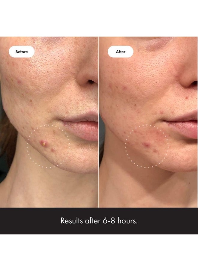 Mighty Patch Hero Cosmetics Invisible+ Patch - Daytime Hydrocolloid Acne Pimple Patches for Covering Zits and Blemishes, Ultra Thin Spot Stickers for Face and Skin (24 Medium and 15 Small Patches)