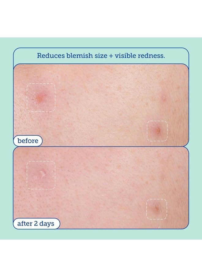 Skinfix Acne+ 2% BHA Acne Spot Treatment: Clinical-Strength, Rapid-Acting Acne Treatment that Reduces Blemish Size and Redness, Plus Prevents New Acne Pimples from Forming, 0.5 oz