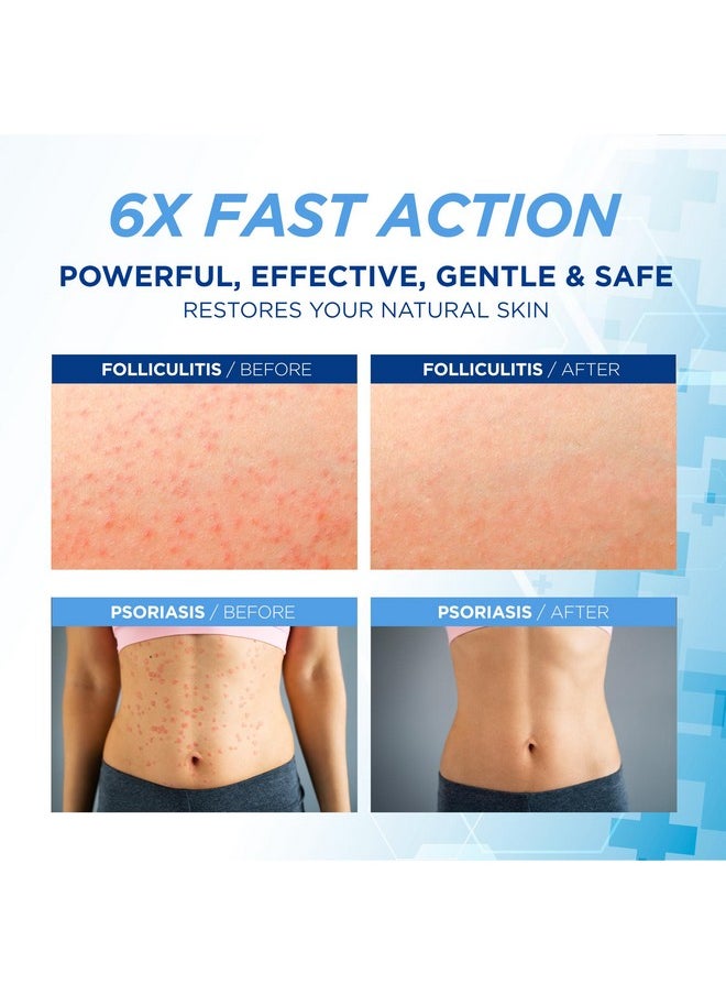 Folliculitis Treatment Cream: Effective Treatment for Folliculitis Scalp Face and Body 100g