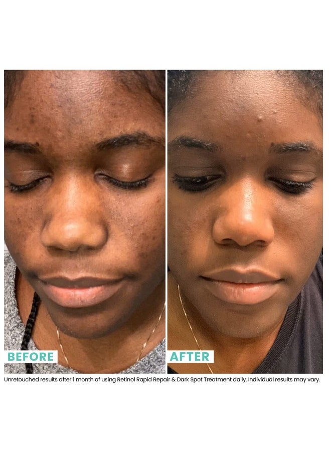 USRx® Retinol Rapid Repair Treatment, Fast-Absorbing, Targets Fine Lines, Hyperpigmentation, and Blemishes, Fragrance-Free with Retinol, Squalane, Niacinamide and Kojic Acid, 1.0 Fl Oz