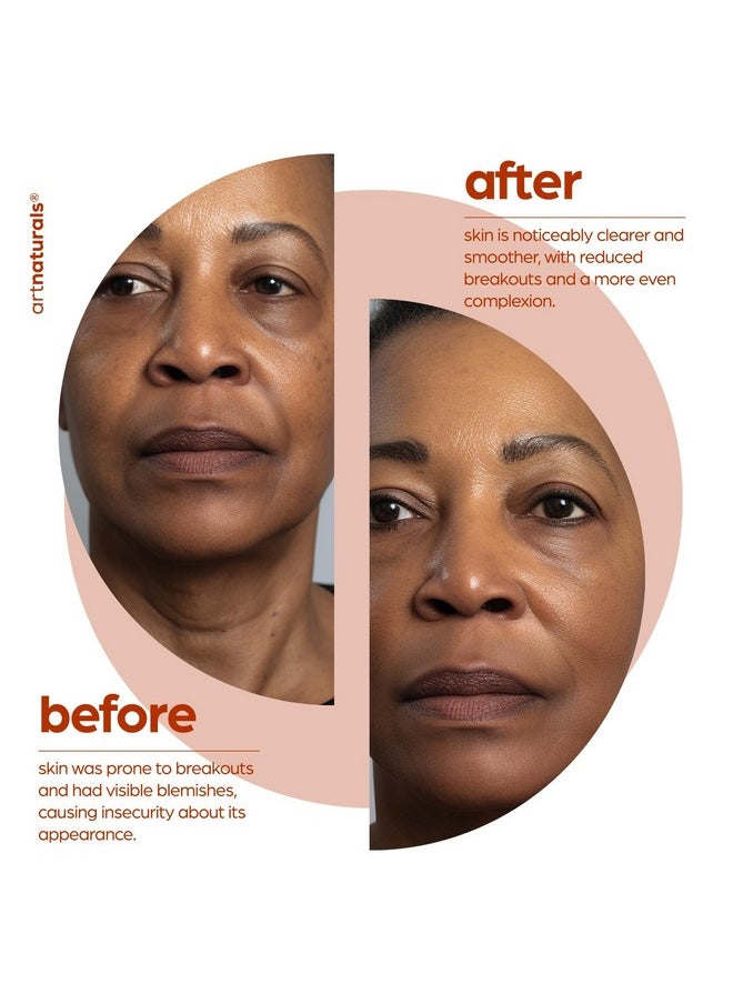 artnaturals Salicylic acid Serum - Advanced Serum with 2% BHA - Helps control oil production- Pore Reducer - 1 oz