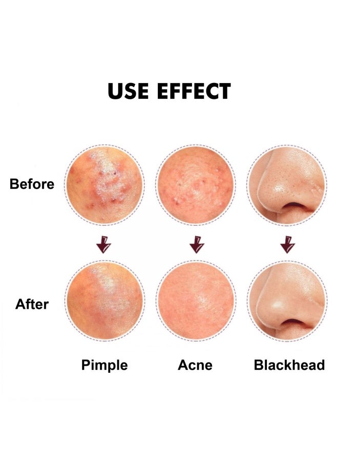 FIXBODY Blackhead and Splinter Remover Tools - Stainless Steel Professional Easily Cure Pimples Whiteheads Comedones Acne Zit Ingrown Hairs and Facial Impurities Bend Head Tweezer Surgical Kit