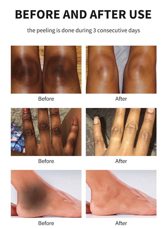 Peeling Oil for Dark Skin, Green Extra Strength Exfoliating Body Peeling Oil, Chemical Peel Solution for Hands and Feet, Effective Exfoliation for Smooth and Radiant Skin