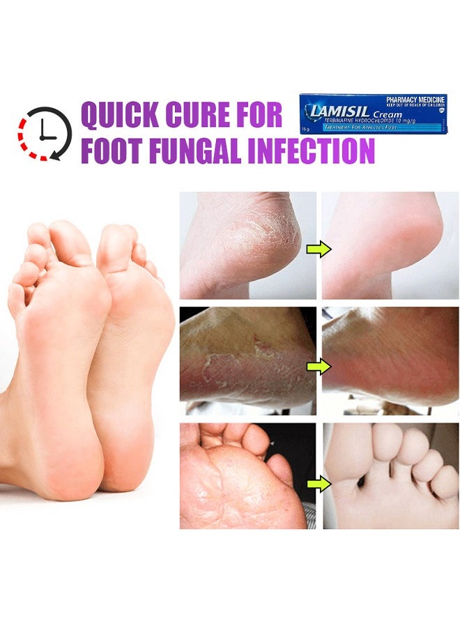 Athletes Foot Cream, Give Skin a Super Smooth Finish And A Healthy Glow, Original Formula Contains Antibacterial Properties To Help Fight Infection In Broken Skin, Protect The Damaged Epidermis
