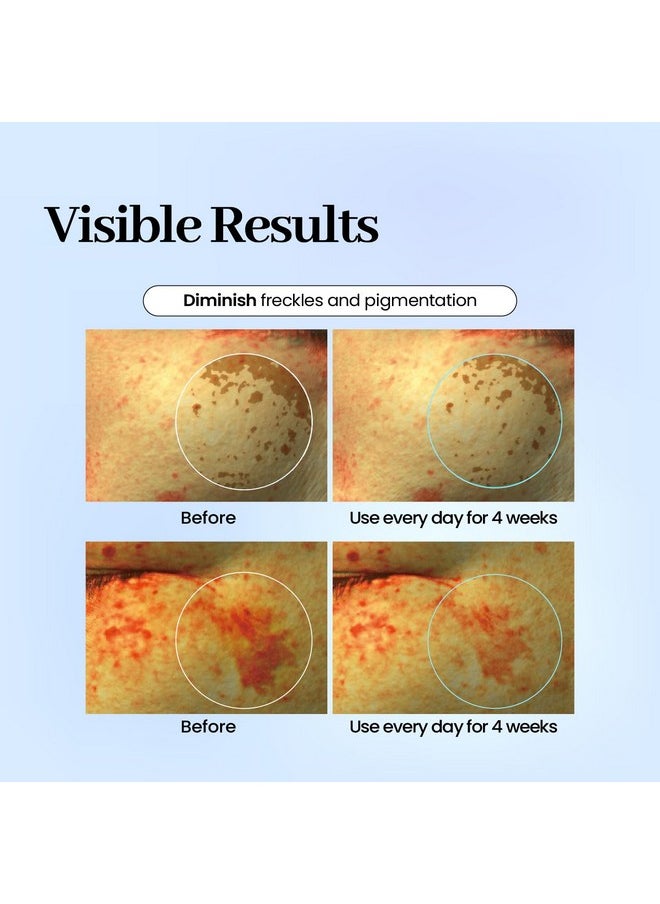 Labottach Dark Old Brown Spot remover Melasa, Freckles, Blemishes, Sun spots, ACNE scars Relieve Patch Mask for 4 weeks, use on the face, hand with Ozonated Olive Oil, Alpha-Arbutin (32, 32, Count)