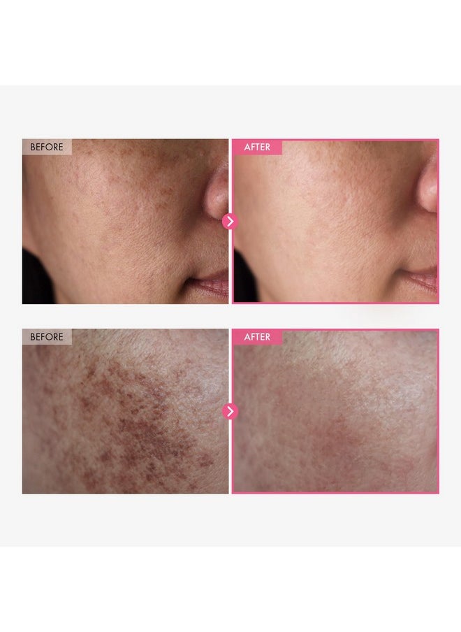 TOSOWOONG Arbutin 7% + Tranexamic Acid 4% Cream, 70,000ppm Arbutin, 40,000ppm TXA, Niacinamide, Glutathione, Dark Spots, Freckle, Blemishes, Pigmetation, Korean Skin Care, 50ml, 1.69 fl.oz.
