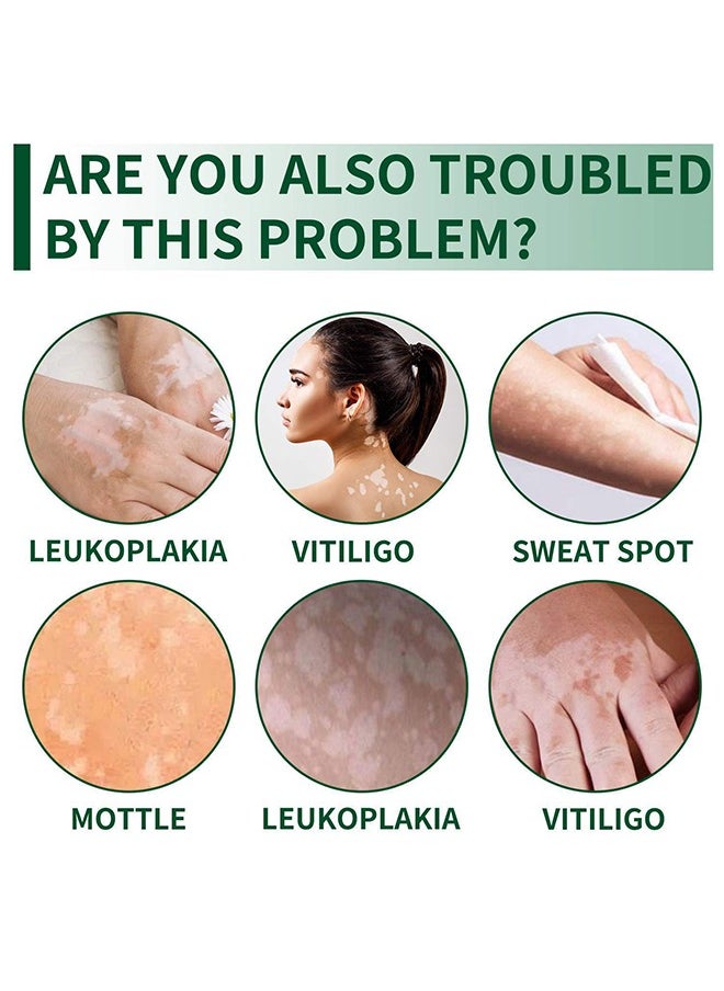 Vitiligo Health Cream, Vitiligo Removal Ointment, Effective Vitiligo Treatment Soothing Cream, Anti Inflammatory White Spot Mycosis Treatment Cream, Soft And Gentle Leukoplakia Disease Cream