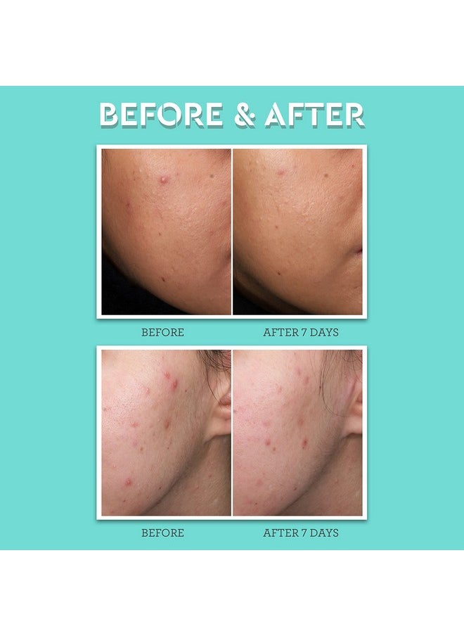 Bliss Clear Genius Acne Spot Treatment - Maximum Strength 2% Salicylic Acid Shrinks Blemishes - Clean, Vegan, Cruelty-Free, 0.5 Fl Oz