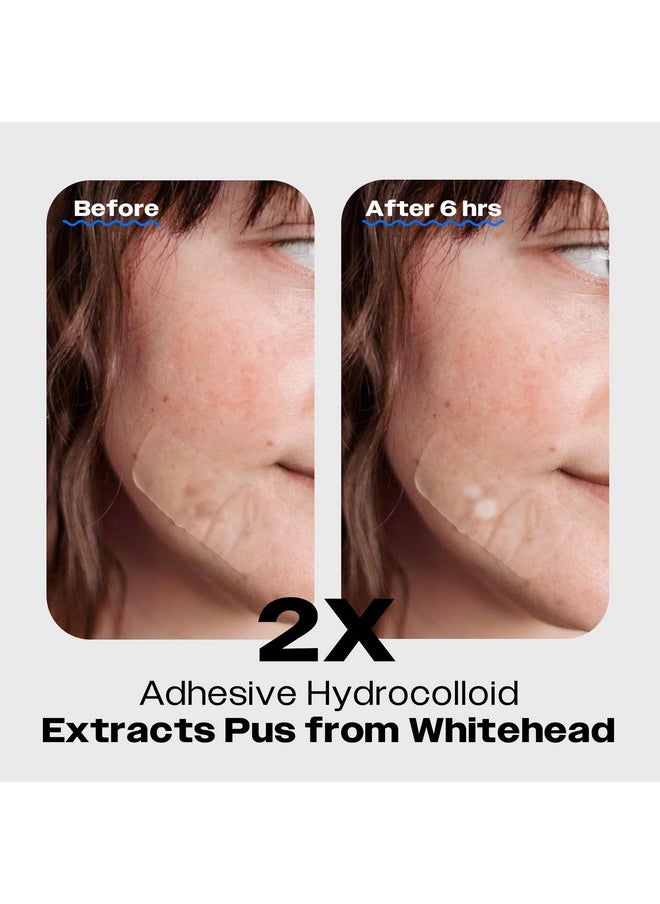 AVARELLE ZITOUT Large Hydrocolloid Pimple Strips (16 Patches) | Vegan Nose Patches for Pores Tea Tree | Chin Acne Patches for Face | Hydrocolloid Bandages for Acne | FSA & HSA Acne Treatment