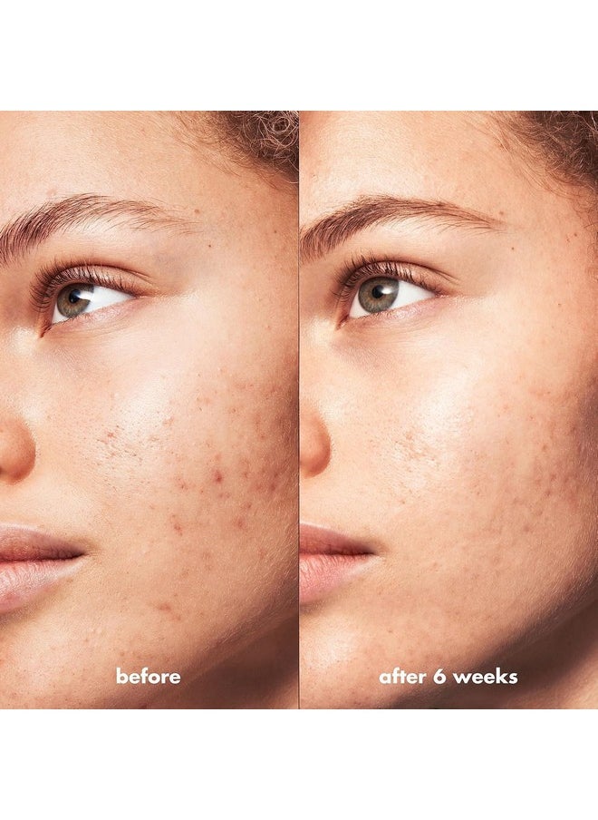 e.l.f. SKIN Blemish Breakthrough Triple-Acid Resurfacing Serum, Hydrating Night Serum For Fighting Blemishes, Helps Improve Skin Tone & Texture