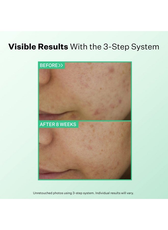 StriVectin Multi-Action Clear Gentle Daily Clarifying Cleanser for Acne Blemished Skin and Break Outs, 5 fl oz