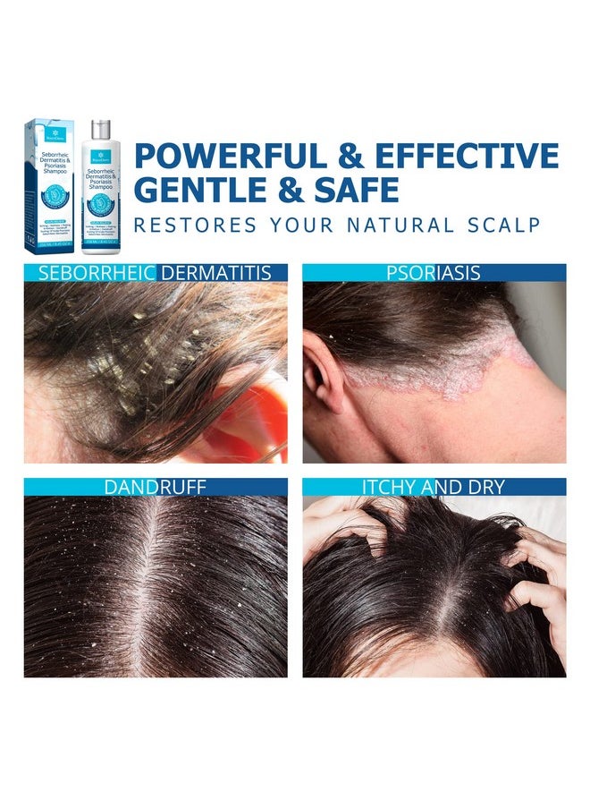 Roycederm Psoriasis Shampoo, Seborrheic Dermatitis Shampoo, Folliculitis Shampoo, Dandruff Shampoo, Scalp Psoriasis & Seborrheic Dermatitis Treatment, Dry Itchy Scalp Treatment