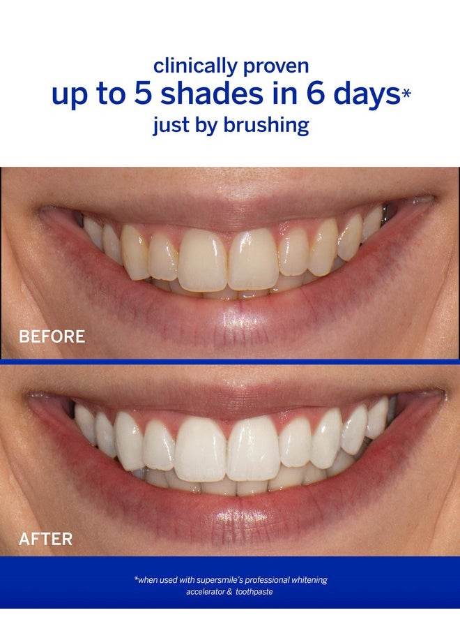 Supersmile Professional Whitening Accelerator - Powerful Whitening without Sensitivity - Safe and Effective on Dental Restorations (3.6 Oz)