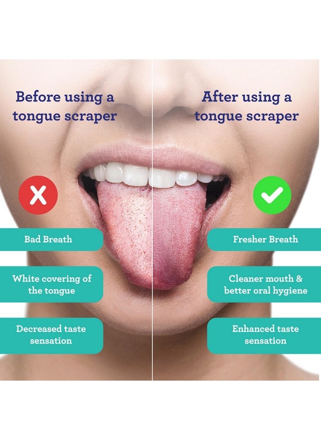 GuruNanda Tongue Scraper for Adults (2 Pack) with Travel Case, 420 Medical-grade 100% Stainless Steel Tongue Cleaner, Aids in Fresh Breath & Oral Care