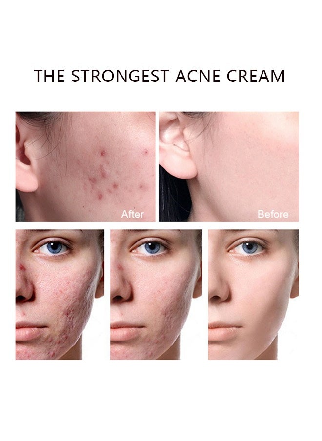 Blemish Cream, Facial Oil Control Acne Cream, for Fast Acne Removal for Oily and Acne-prone Skin, Non-Irritant, Women 30g