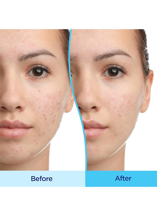 Differin Acne Treatment Gel, 30 Day Supply, Retinoid Treatment for Face with 0.1% Adapalene, Gentle Skin Care for Acne Prone Sensitive Skin, 15g Tube