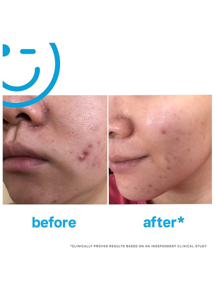 Kate Somerville EradiKate Daily Foaming Cleanser Acne Face Wash for Visibly Clearer Skin 4oz120ml