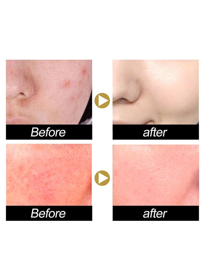Advanced Snail 92 All In One Cream,Moisturizing Acne Scar Removal Cream , Anti-Aging & Wrinkle Removal and Whitening, Improve Skin Nourishing Collagen Essence Cream For Improve Damaged Skin 100ml