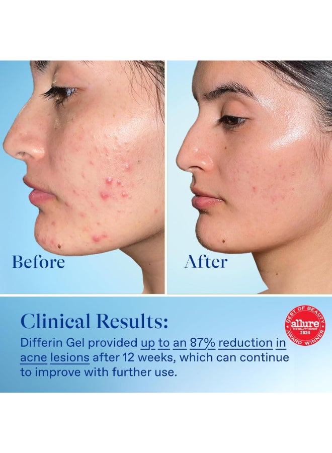 Acne Treatment With Adapalene Gel 0.1% Packaging May Vary 15grams