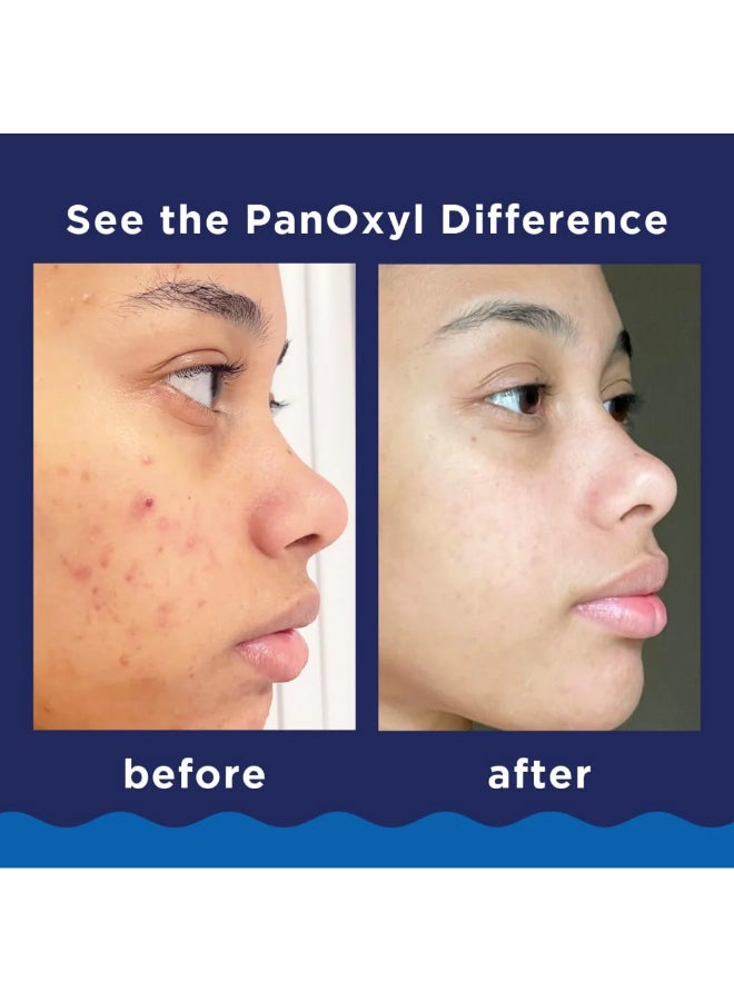 Pack Of 2 Acne Foaming Wash 156grams