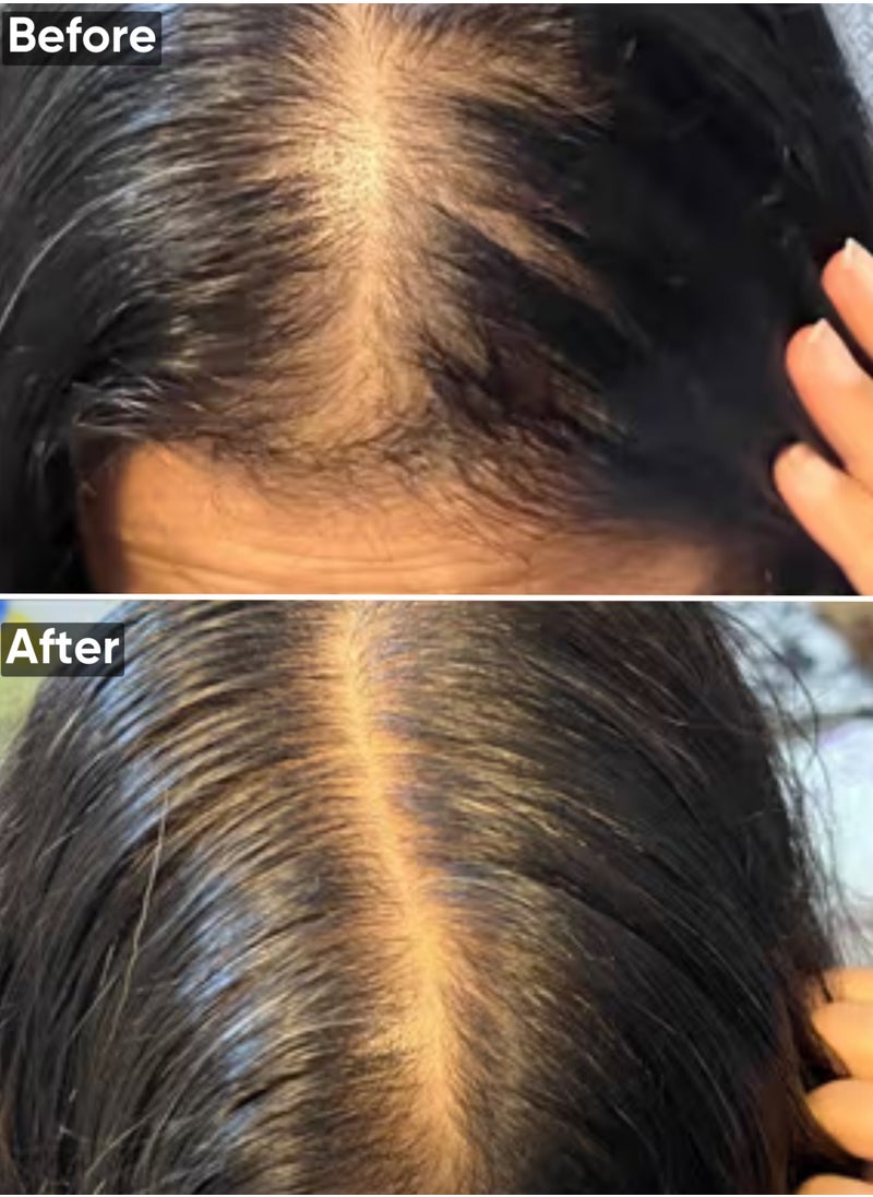 Hair Growth Serum with Procapil, Capixyl, Redensyl, Anagain And Baicapil For Hair Fall Control And Hair Growth in Men And Women