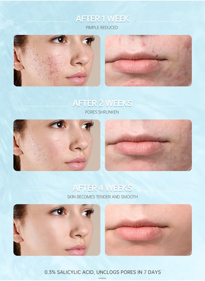 Salicylic Acid Acne Treatment Cream - Whitening Facial Treatment Hyaluronic Acid Black Dots Remove Skin Care Beauty Health 15ml