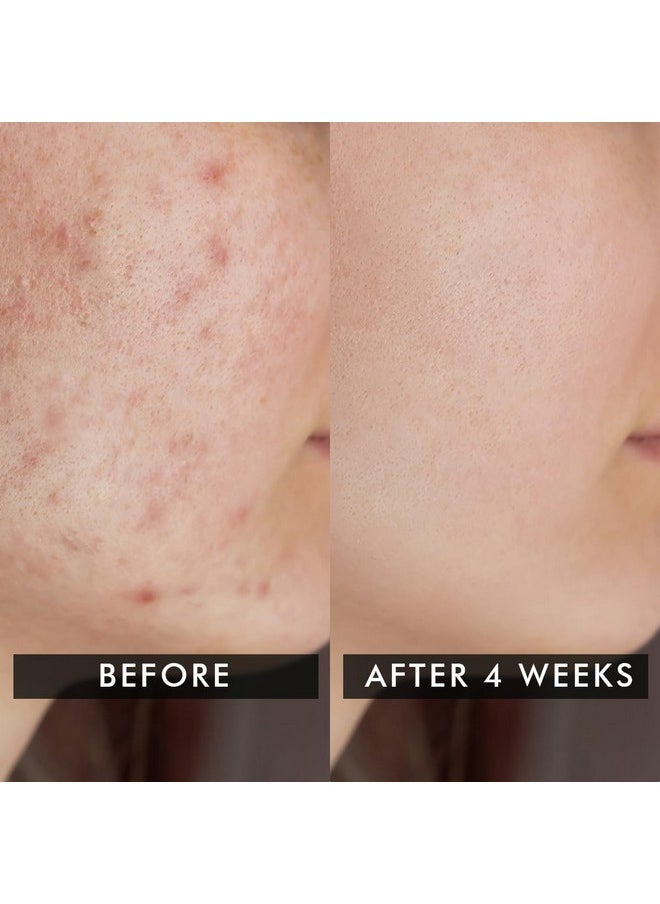 ® 2% Salicylic Acid Cream | 50G | Moisturizer For Oily Acne Prone Skin, Face Cream For Men & Women, For Acne & Oil Control, Itchiness & Redness, Non Greasy Gel Cream - Flashfix